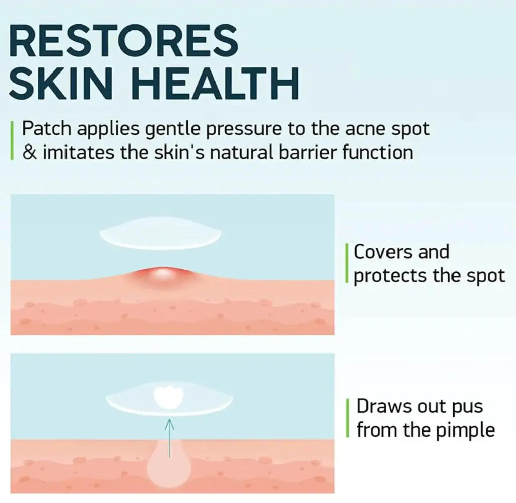 Restores skin health pimple patch applies gentle pressure acne spot imitates skin natural barrier covers protects spot draws out pus from pimple healing process