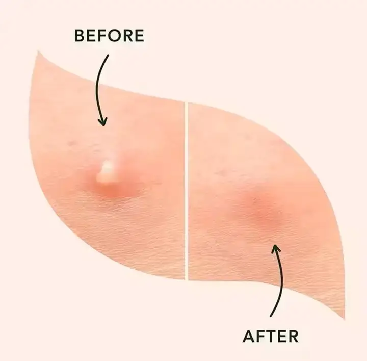 Pimple before after treatment exposed pus reddish inflamed acne spot almost disappeared healed clear skin acne patch results transformation